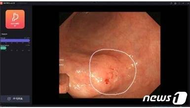 혁신의료기기로 지정된 '웨이메드 엔도'(WAYMED endo ST CS)(식품의약품안전처 제공)