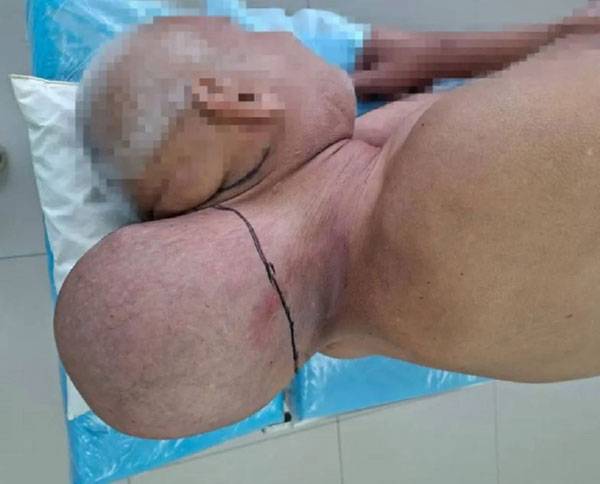 한 러시아 남성이 16년 동안 목에 생긴 거대한 종양을 방치한 끝에, 결국 수술로 제거한 사실이 전해졌다./사진=뉴욕포스트