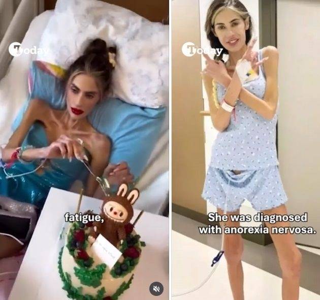 튀르키예 인플루언서 니할 칸단(30)이 심각한 거식증을 앓다가 사망했다. SNS 캡처