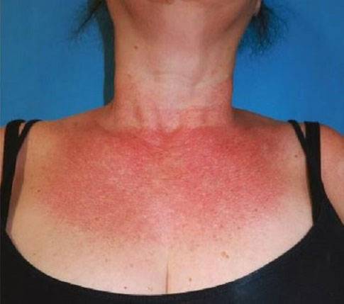 시바트 다형피부증이 나타난 환자./사진=Australian Journal of General Practice