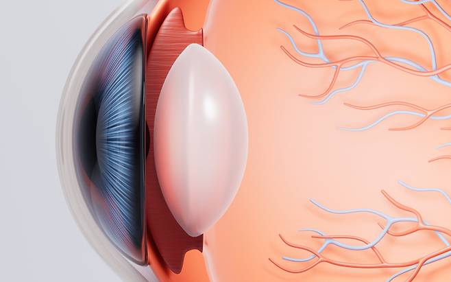 백내장은 눈 속 투명했던 수정체가 혼탁해지면서 덩달아 시야도 뿌얘지는 질환이다. 그림 속 하얀 바둑알 모양이 수정체다.