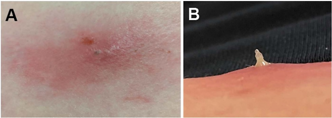 사람의 팔을 파고든 룬드파리 유충의 모습. Parasitology 저널 제공.