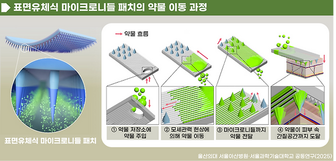 표면유체식 마이크로니들 패치의 약물 이동 과정 ⓒ서울아산병원