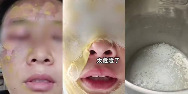 인터넷상에 떠도는 텀블러 세척법을 함부로 따라 했다가 얼굴에 큰 화상을 입은 중국 여성.