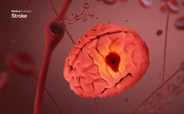 뇌졸중의 한 종류인 뇌출혈은 치사율이 50%에 이르고 생존하더라도 마비나 언어장애 같은 심각한 후유증을 남길 수 있어 예방이 필요하다. 사진은 기사의 특정 사실과 관련 없음. 클립아트코리아