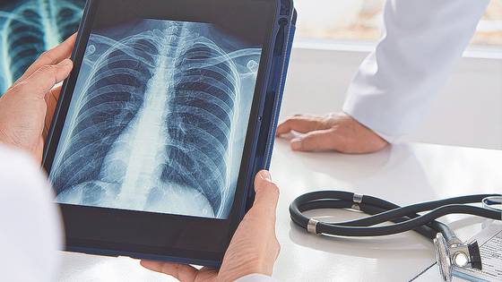 초기 증상이 거의 없는 폐암은 흉부 X선 검사와 저선량 흉부 CT를 통해 조기에 발견하는 것이 바람직하다.