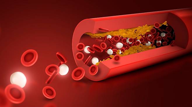 이상지질혈증은 지단백의 대사 이상에 의해 발생하는 질환이다|출처: 클립아트코리아