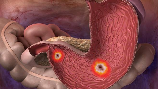 헬리코박터 파일로리균은 위염, 위궤양, 위암의 주요 원인균으로 알려져 있다|출처: 클립아트코리아