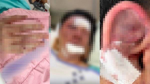 수탉이 공개한 당시 부상 상태. 피의자 A 씨 일당이 얼굴과 귀 부근을 무차별 폭행하는 과정에서 얼굴에 부상을 입었고, 이를 막으려다 손목 골절상을 입었다. 숲 수탉 채널 갈무리