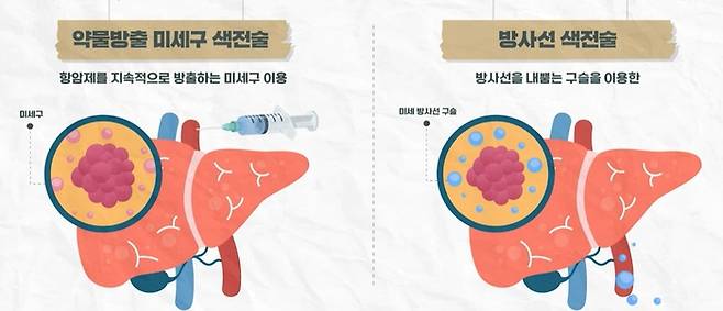 최신 간암 색전술