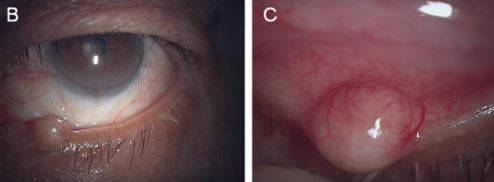 눈에 천천히 종양이 자라난 80대 남성이 ‘마이봄샘 경색’이라는 드문 질환을 진단받은 사례가 보고됐다./사진=큐레우스
