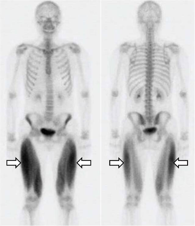 횡문근융해증 환자의 뼈스캔 사진 비교. 오른쪽 사진 화살표 쪽에서 근융해 부위가 확인된다. 한승엽 교수 제공