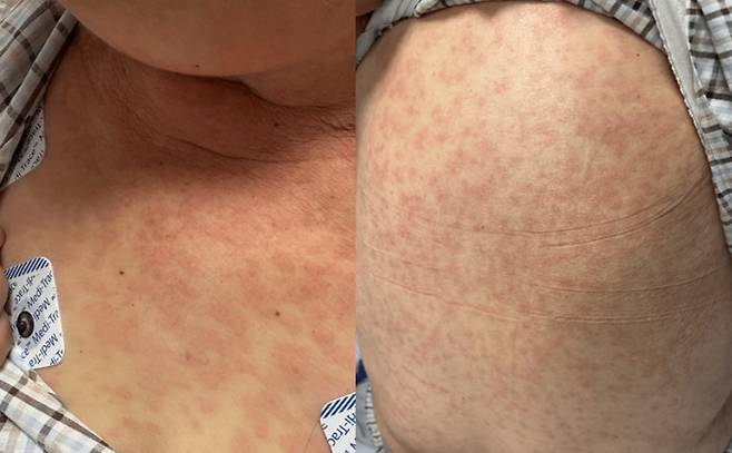 피부 말초 T세포 림프종의 피부 침범으로 전신에 발적이 나타난 70대 여성의 모습. 사진=cureus