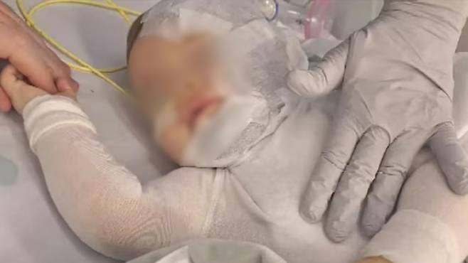 2024년 9월 호주 퀸즐랜드주 브리즈번의 핸론 공원에서 가족들과 피크닉을 즐기다 한 중국인 남성이 부은 뜨거운 커피로 화상을 입은 아기의 모습. 사진은 아기 가족이 호주 언론에 제공한 사진. /사진=호주 AAP