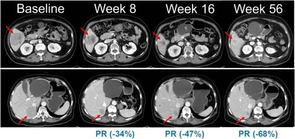 NRAS 돌연변이 흑색종 환자를 대상으로 진행된 벨바라페닙과 코비메티닙 병용요법 임상시험에서 시간 경과에 따른 병변 변화가 관찰된 복부 CT 영상./사진=한미약품