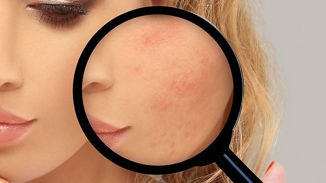 여드름 흉터는 피부 구조에 영구적 변화를 남길 수 있어 초기부터 적극적인 관리가 필요하다|출처: 게티이미지뱅크