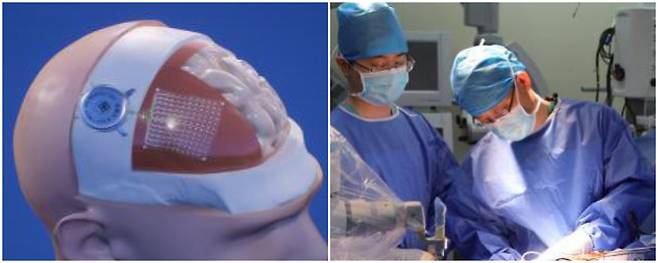 베이나오 BMI 칩 이미지(왼쪽)와 2025년 5월 쉬안우병원에서 칩 이식 수술이 진행되고 있는 모습. /뉴사이버 제공