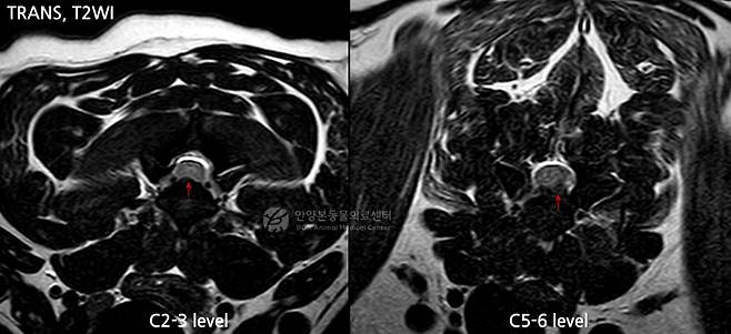 사지마비 증상을 보인 환견의 MRI 영상. 경추 2~3번(C2-3) 부위에서 신경 압박이 확인됐고, 특히 경추 5~6번(C5-6) 부위에서는 디스크가 한쪽으로 심하게 탈출하며 척수를 강하게 누르고 있었(본동물의료센터 제공). ⓒ 뉴스1