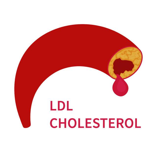 최근 이상지질혈증 치료 가이드 라인에서는 동맥경화성 심혈관질환 환자의 LDL 콜레스테롤 목표치를 55㎎/dL 미만으로 더욱 낮춰 제시했다. 클립아트코리아