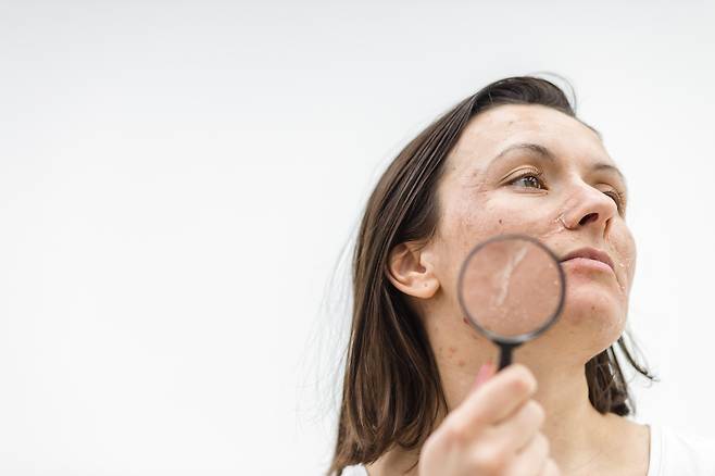 피부가 건조해지면 각질이 도드라지고 가려움이나 붉은기 같은 증상이 나타나기 쉽다. 또한 피부 장벽이 무너지면 알레르기성 피부염이 악화되거나 외부 오염 물질이 모공에 쌓이면서 여드름, 뾰루지 등의 문제가 발생할 수 있다. 특히 봄철에는 야외활동이 증가하면서 피부가 외부 환경에 노출되는 시간이 길어져 이러한 증상이 더욱 심화될 수 있다.<사진출처:게티이미지뱅크>