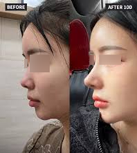 우리보다 과도한 코에 대한 선호가 더 큰 중국 성형외과 광고사진입니다. 턱끝이 부족해서 중안면이 길어 보이는 전형적인 느낌의 얼굴에서 코를 길게 빼는 것은 중안면을 더 길어 보이게 합니다.