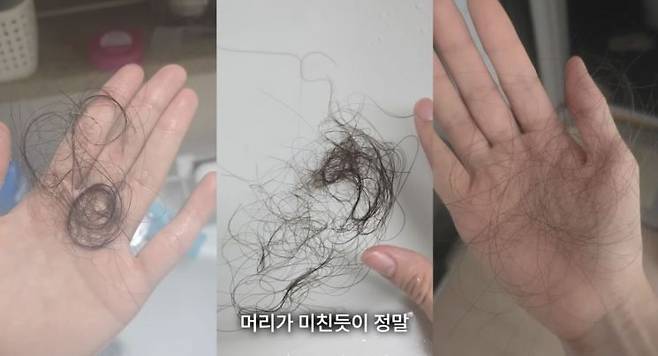 곽혈수는 사건 이후 탈모 등 부작용을 겪고 있다고 토로했다. 곽혈수 유튜브 채널 캡처