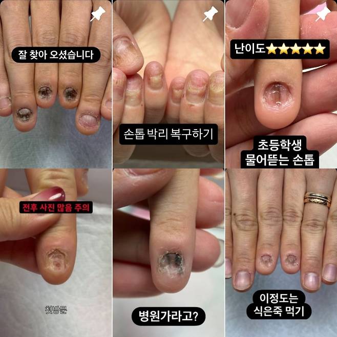 박씨의 소셜미디어 인스타그램에 올라온 손님들의 시술 전 손톱 사진들. '난이도 ★★★★★' '병원 가라고?' '이 정도는 식은 죽 먹기' 같은 문구가 달려 있다. 인스타그램(@by_soeun) 캡처